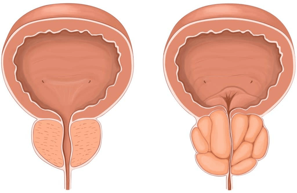 Co se děje s prostatou při prostatitidě