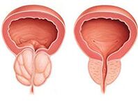 Prostatitida
