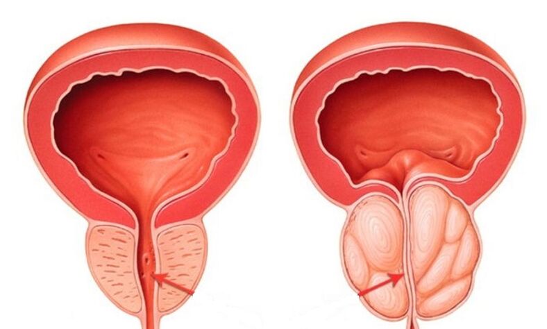 Zdravá a zanícená prostata prostatitidou