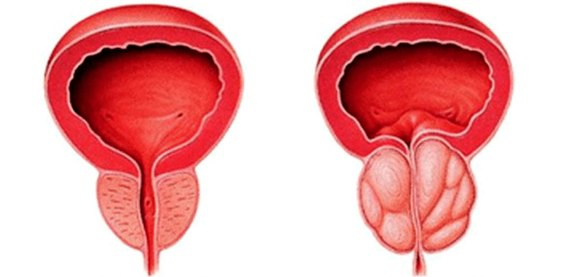 Normální a zanícená prostata